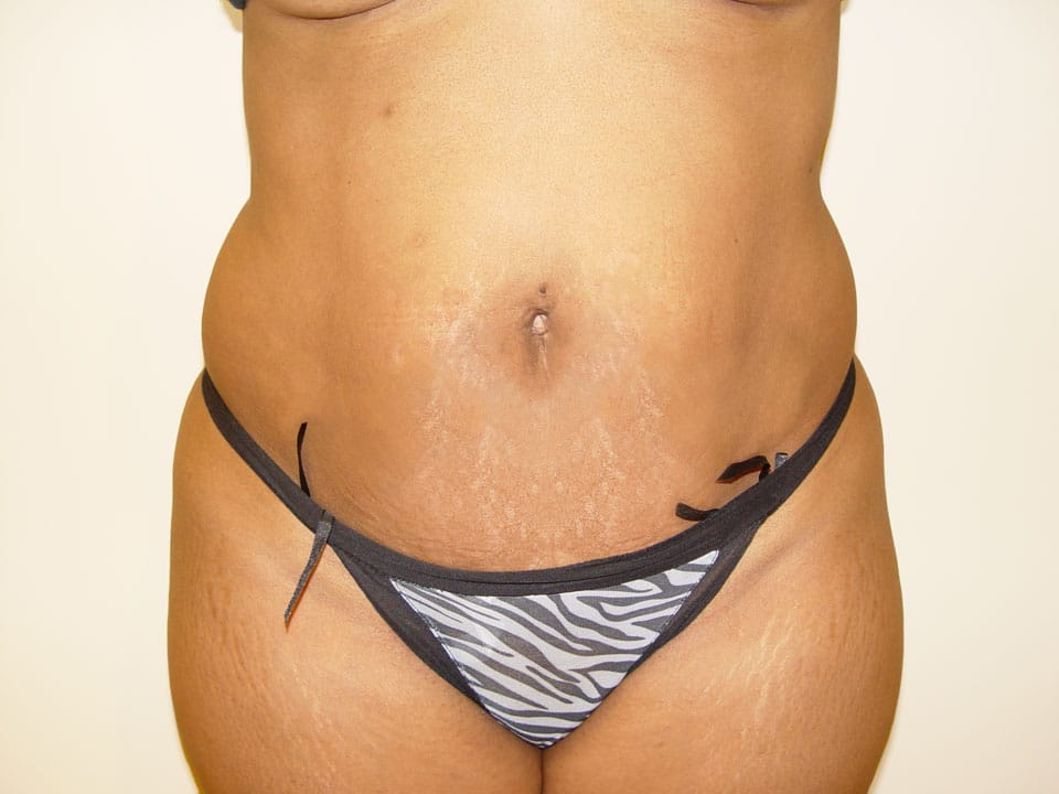 Before & After Patient