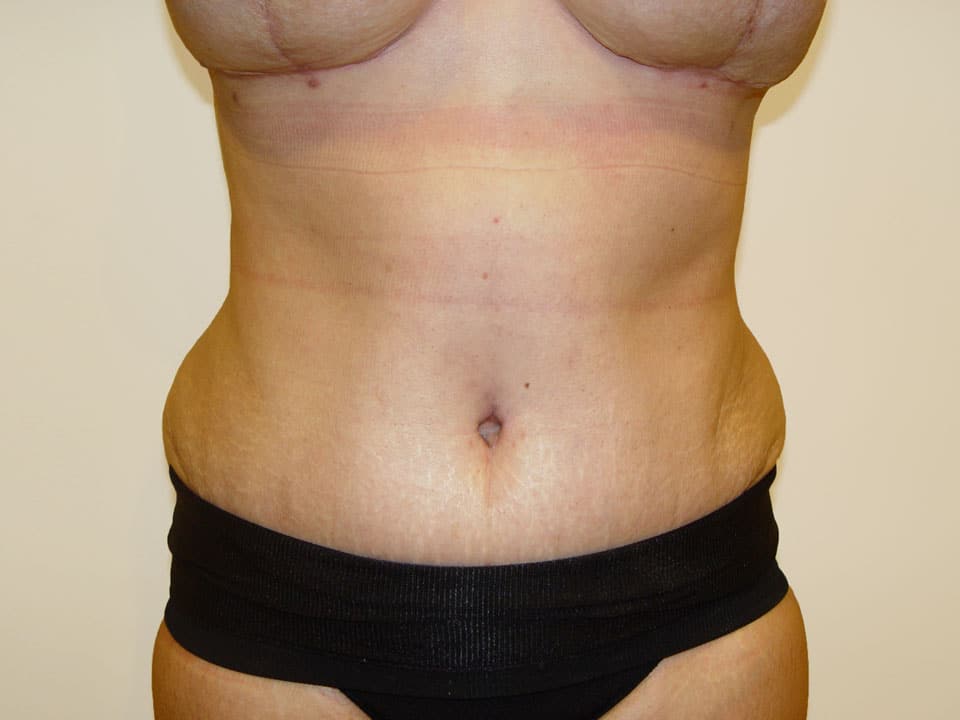 Before & After Patient