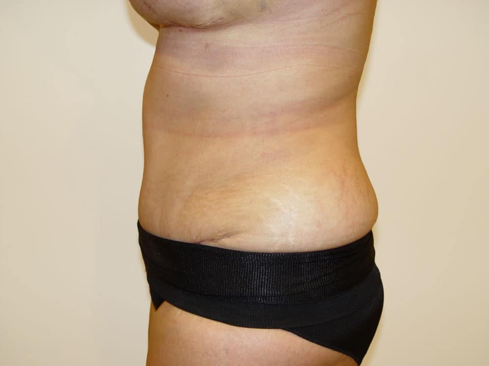 Before & After Patient