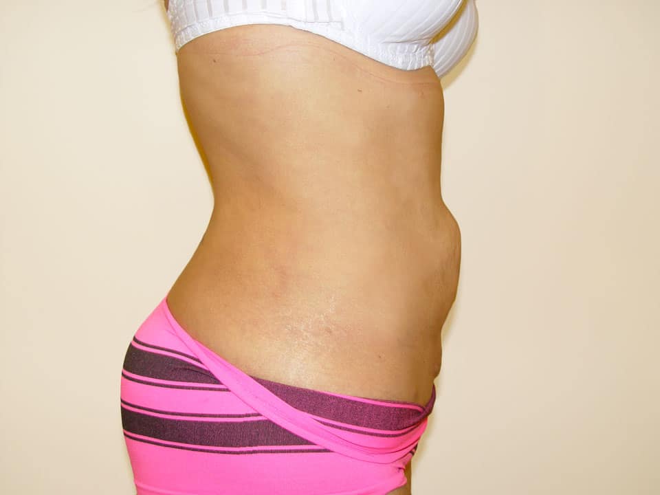 Before & After Patient