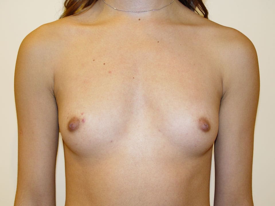 Before & After Patient