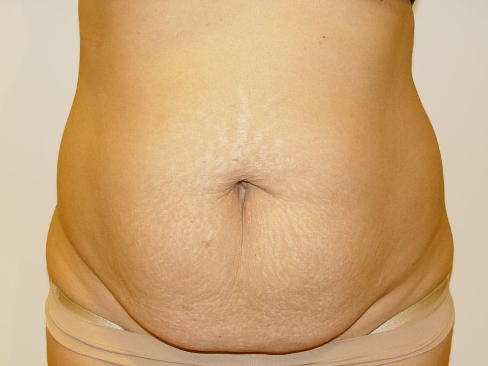 Before & After Patient