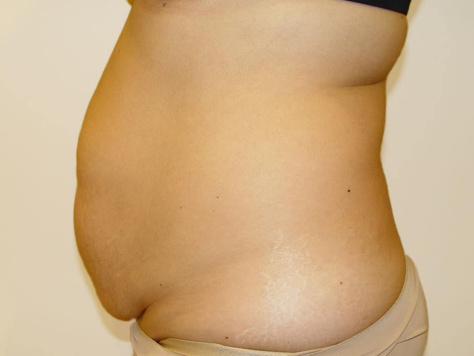 Before & After Patient