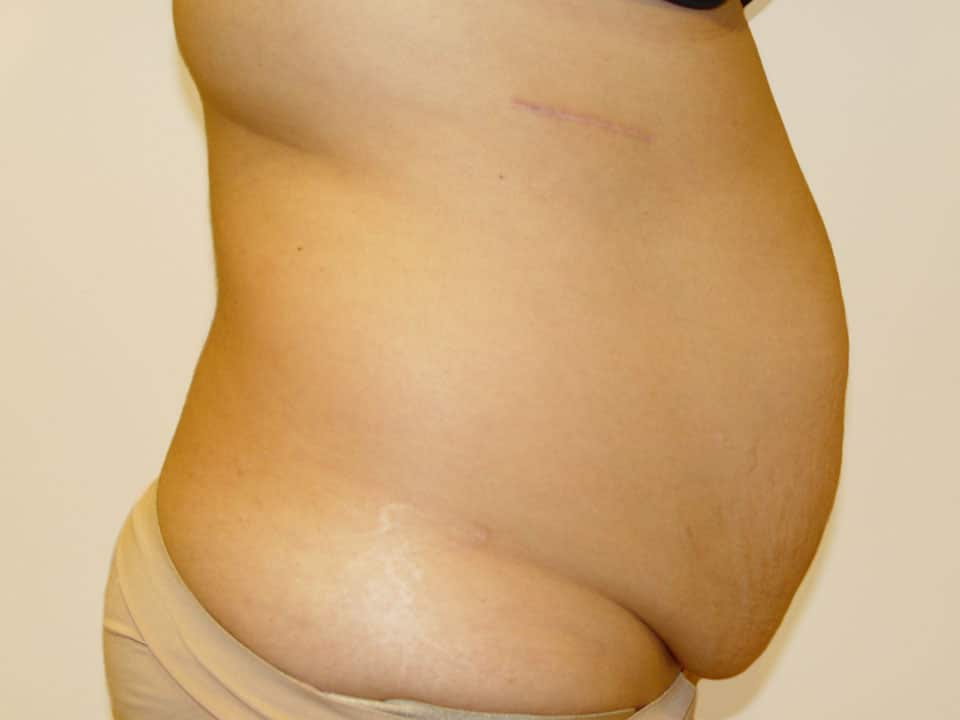 Before & After Patient