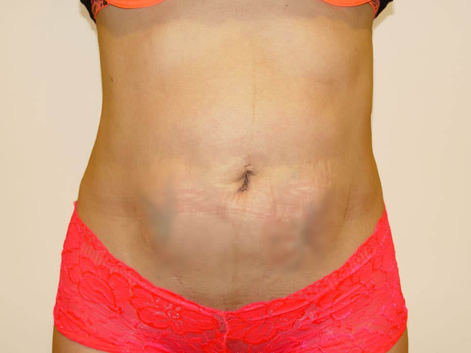 Before & After Patient