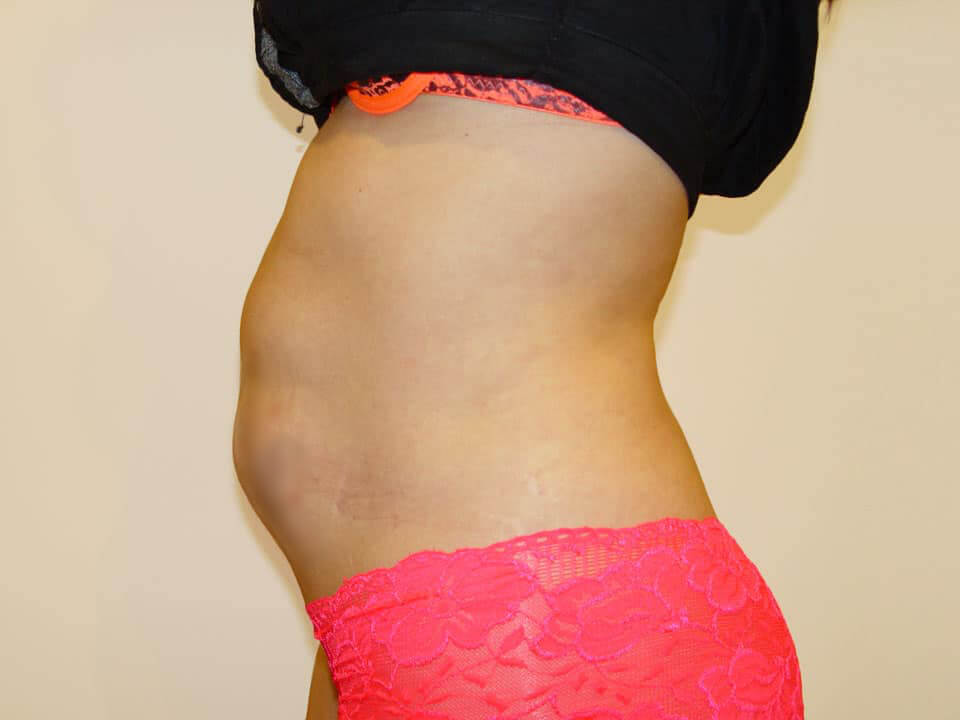 Before & After Patient