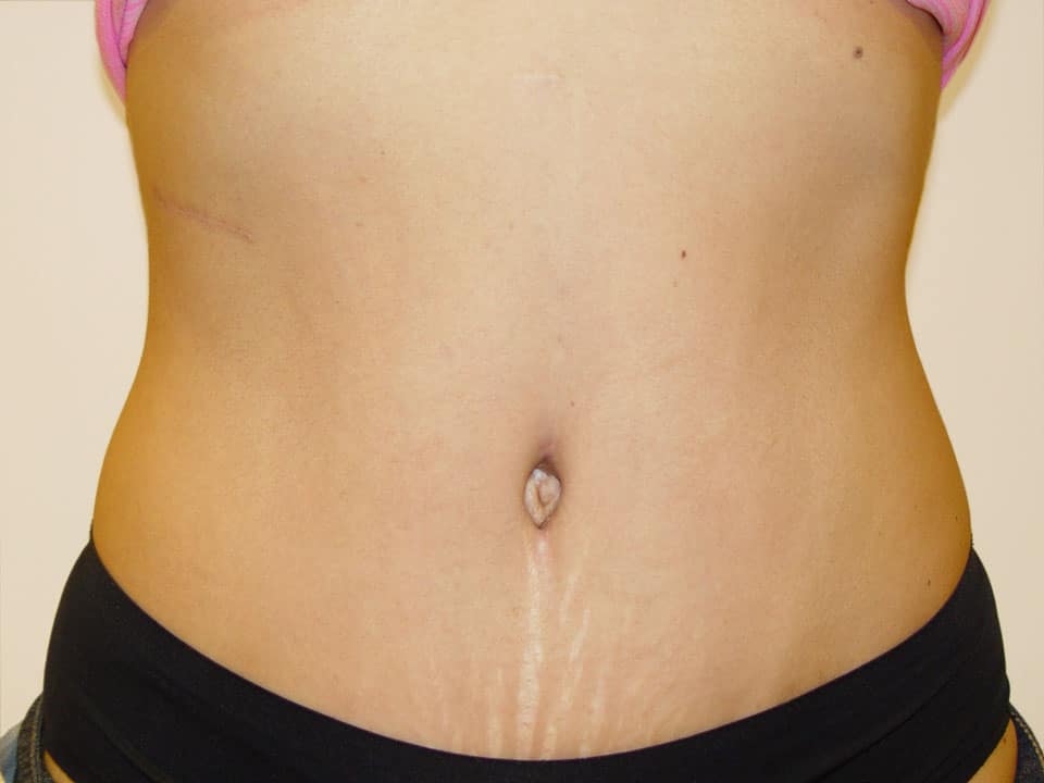 Before & After Patient