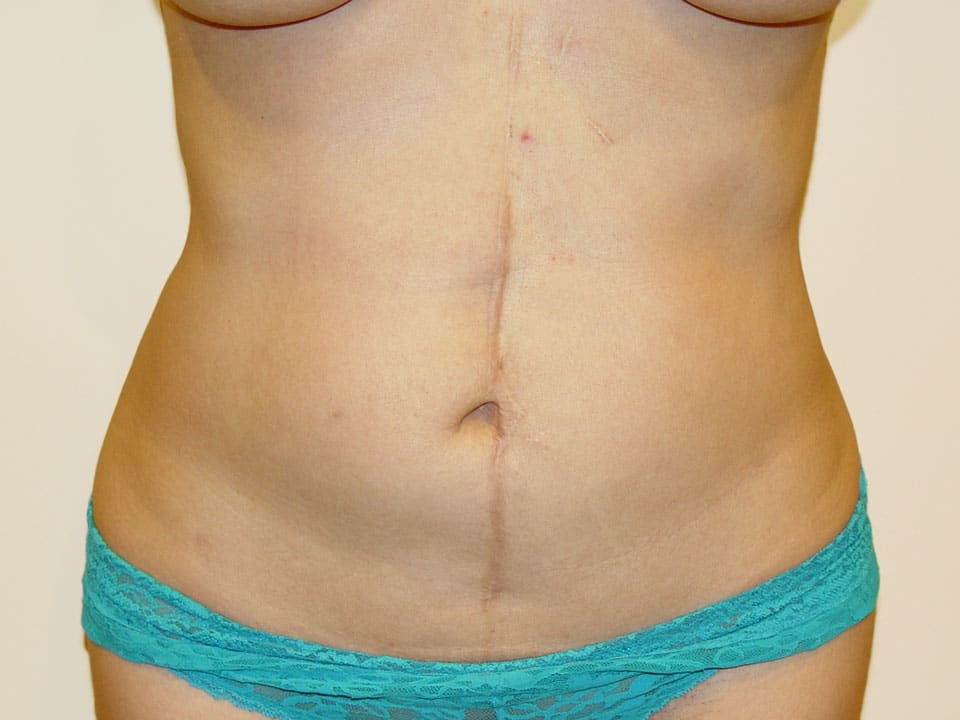 Before & After Patient