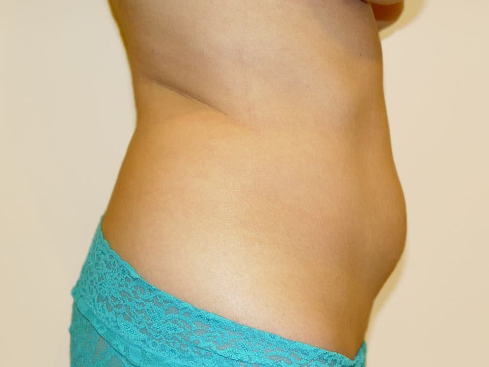 Before & After Patient