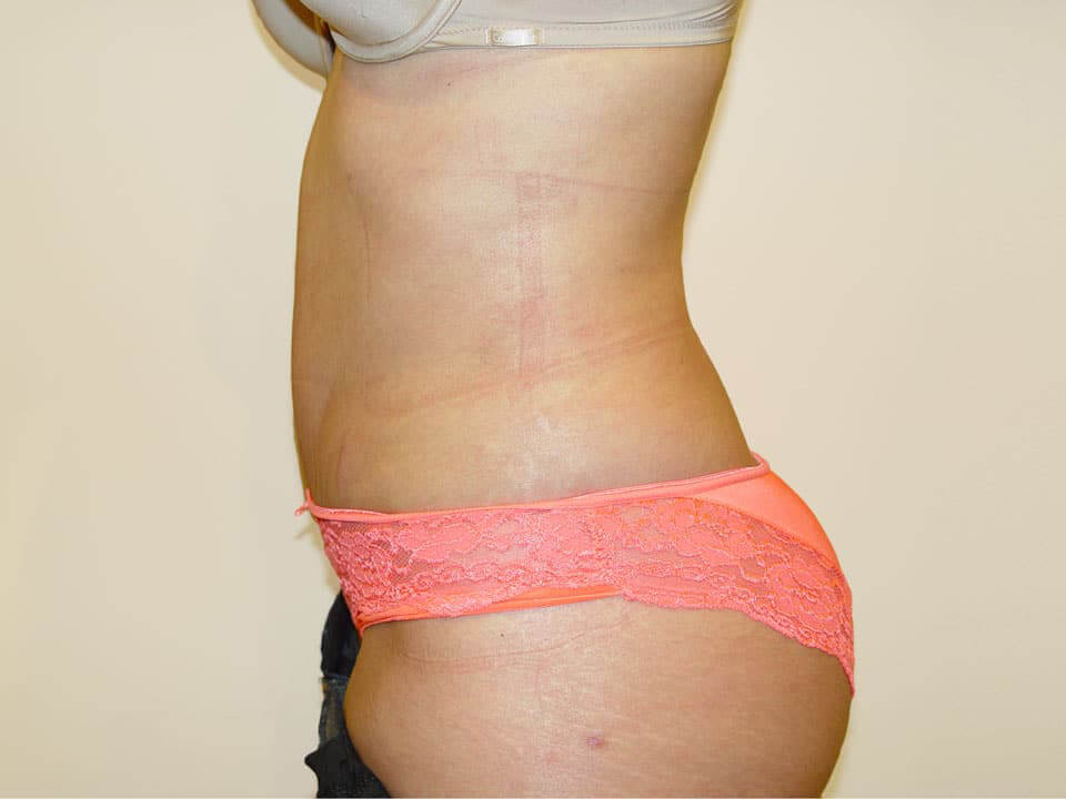 Before & After Patient