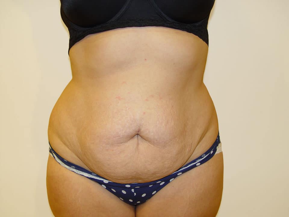 Before & After Patient