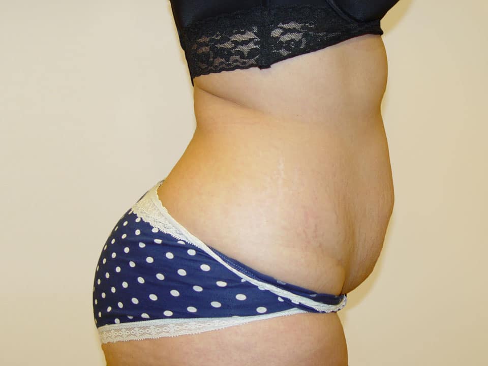 Before & After Patient