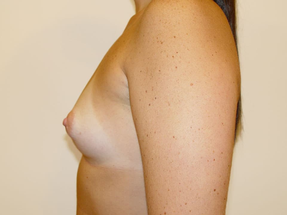 Before & After Patient