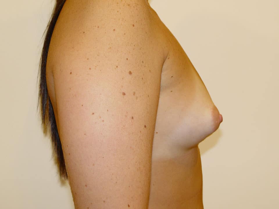 Before & After Patient