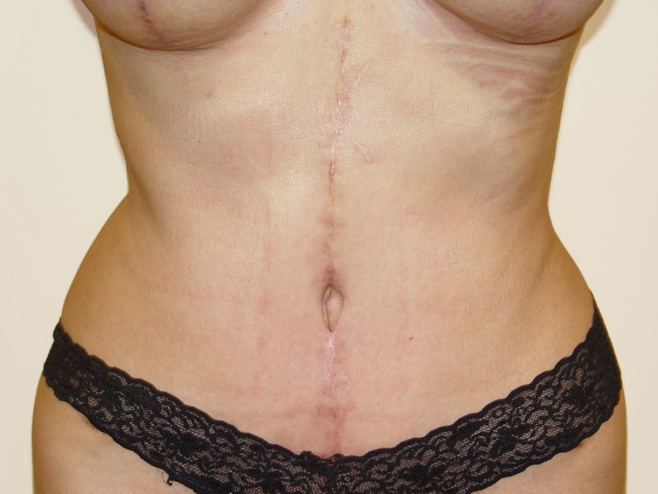 Before & After Patient