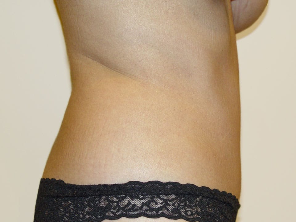 Before & After Patient