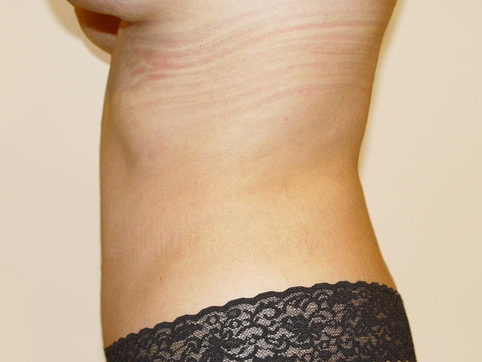 Before & After Patient