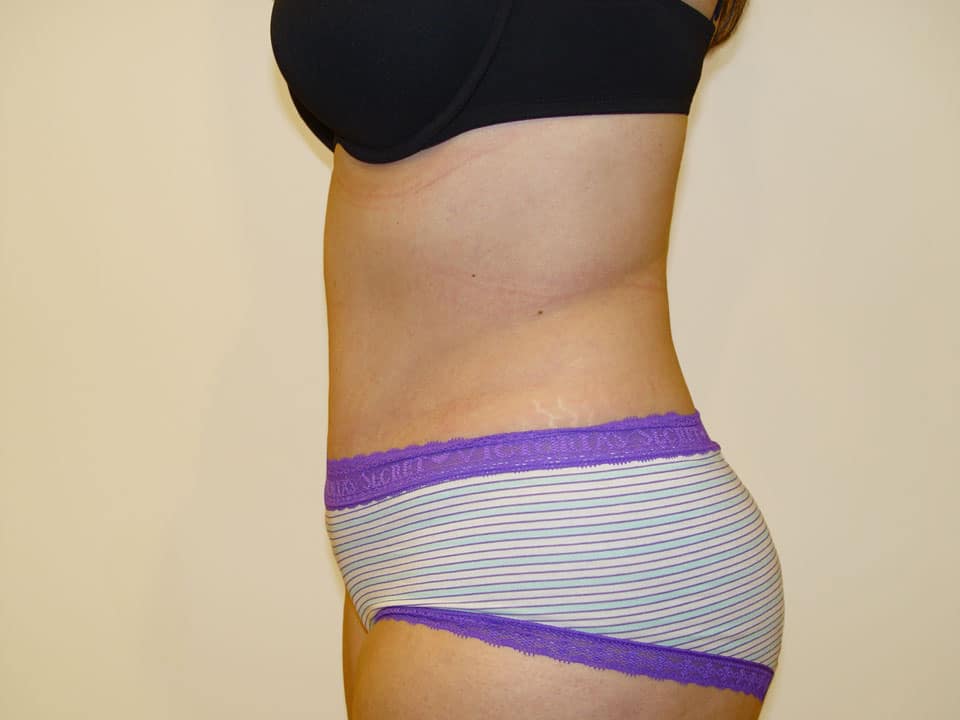 Before & After Patient