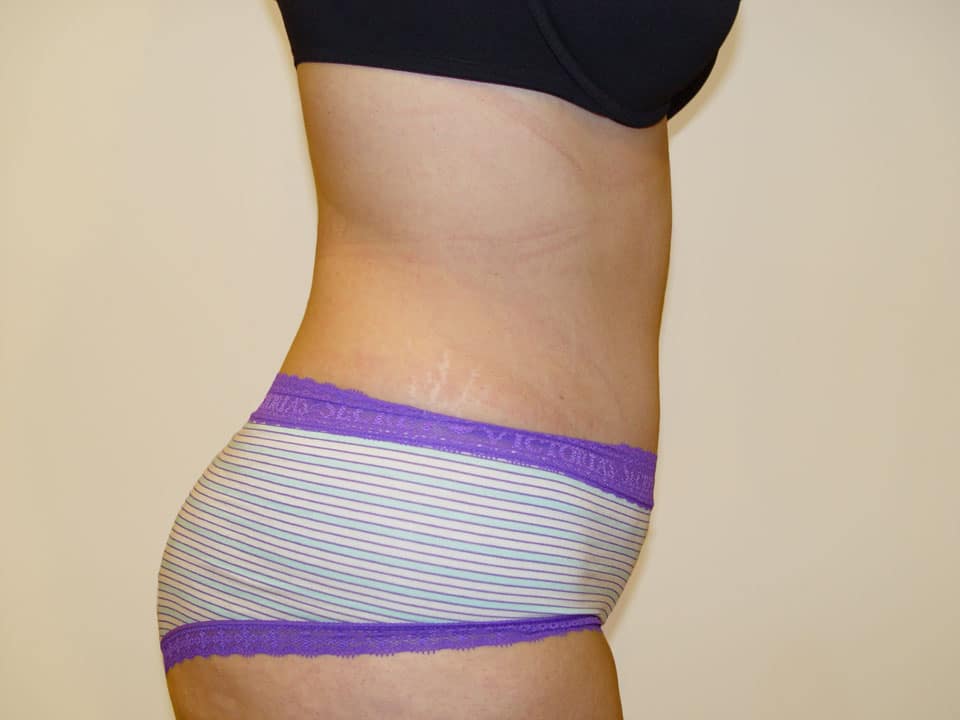 Before & After Patient