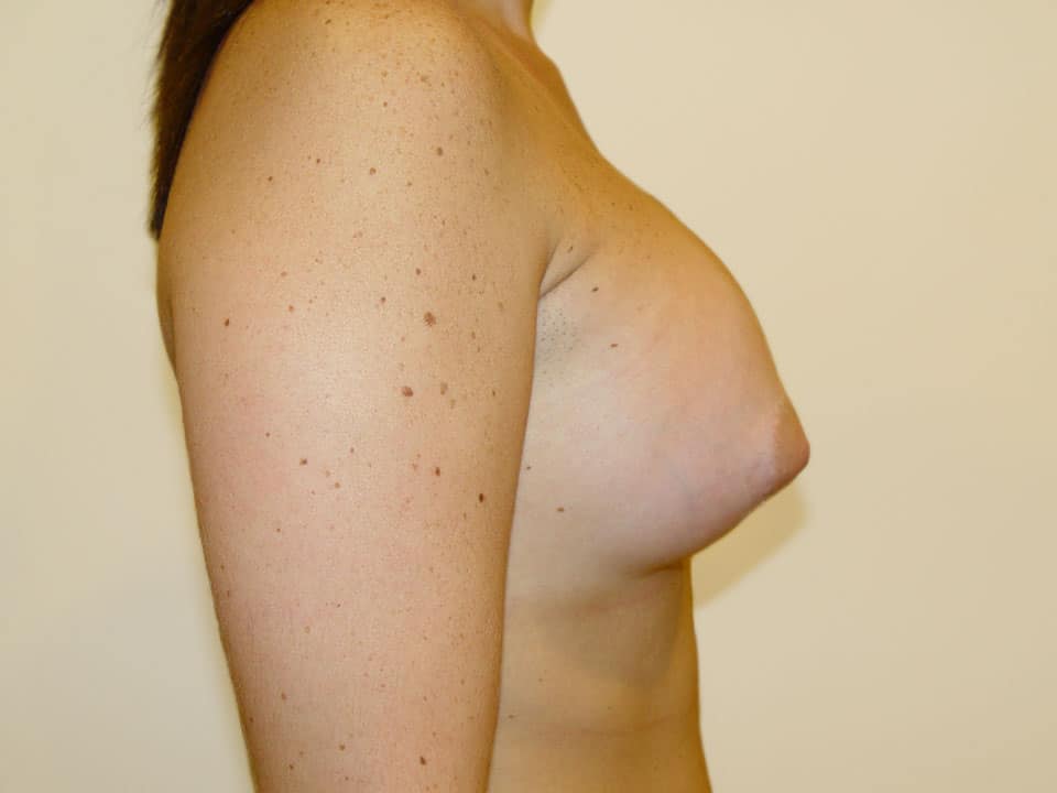 Before & After Patient