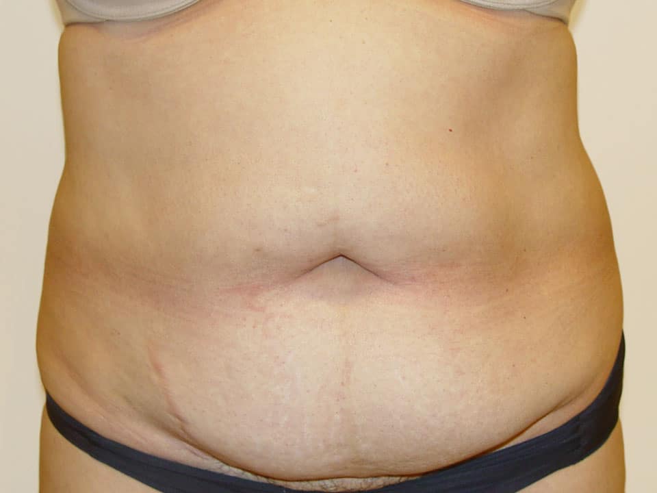 Before & After Patient