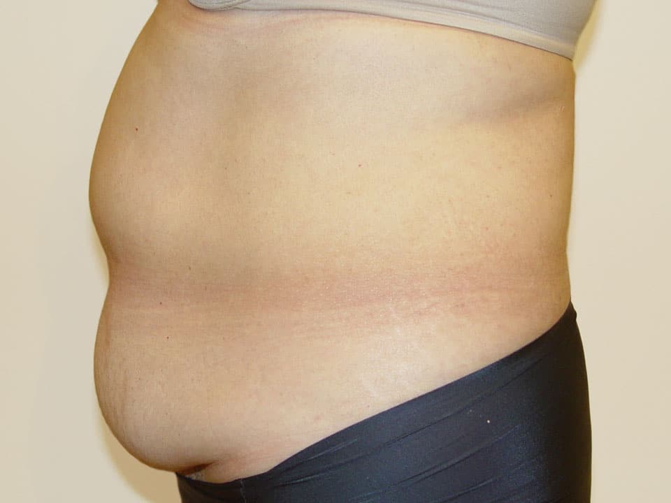 Before & After Patient