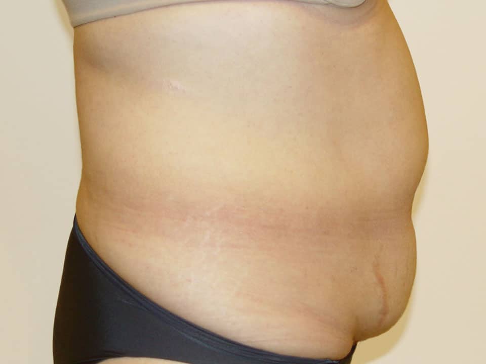 Before & After Patient