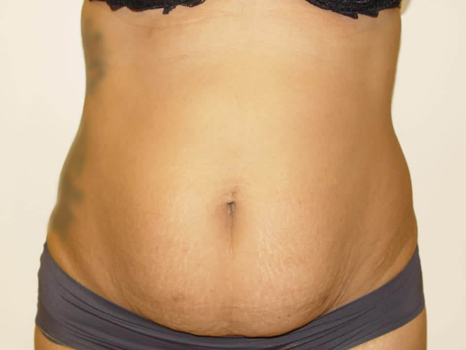 Before & After Patient