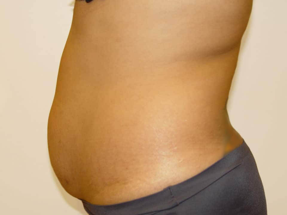 Before & After Patient