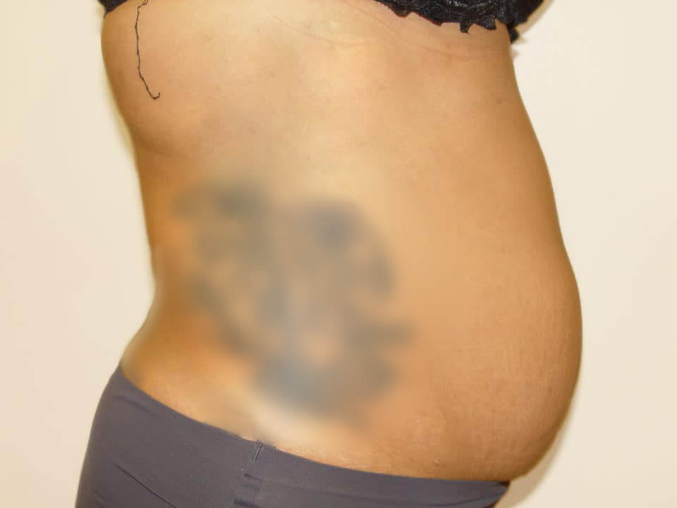 Before & After Patient