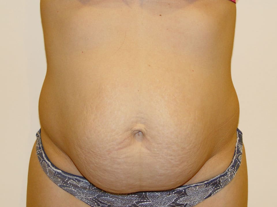 Before & After Patient