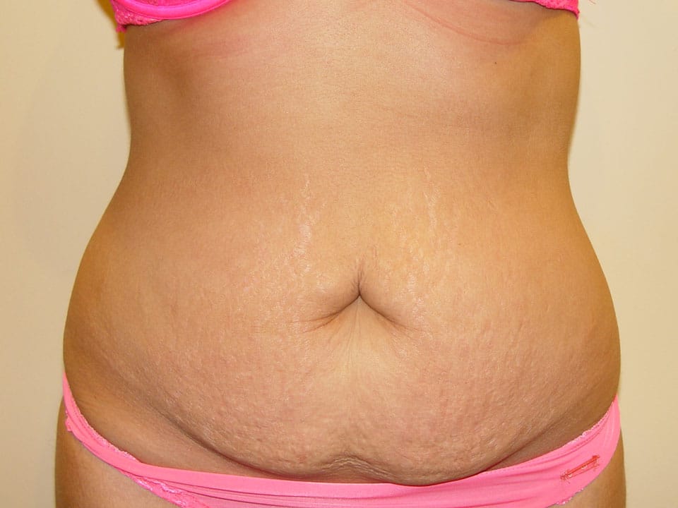 Before & After Patient