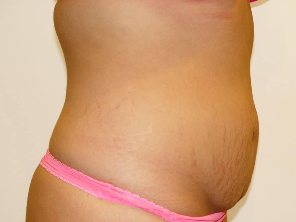 Before & After Patient