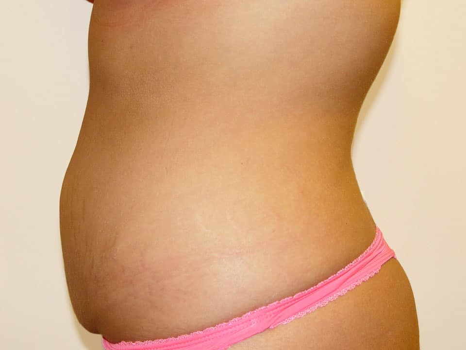 Before & After Patient