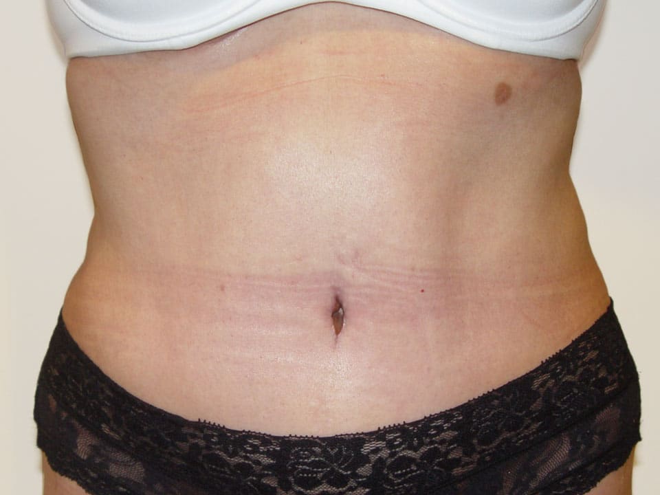 Before & After Patient