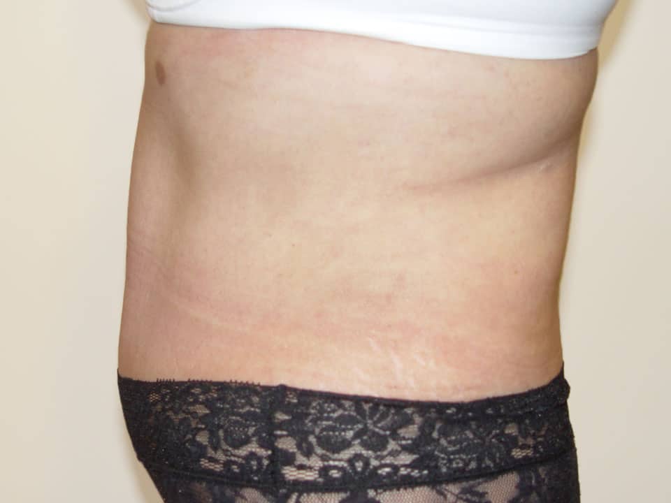 Before & After Patient