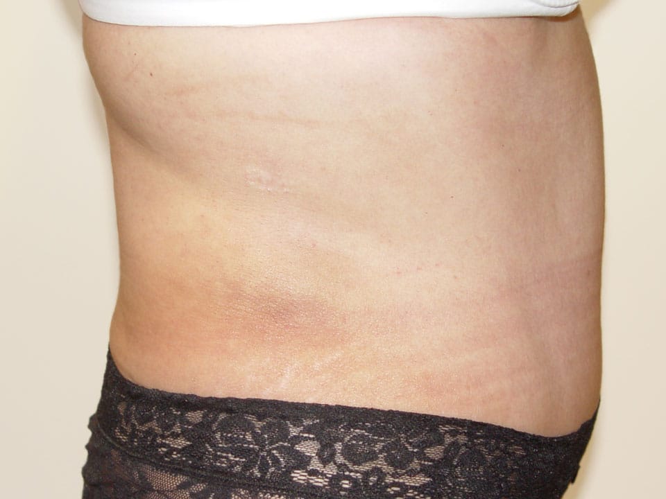 Before & After Patient