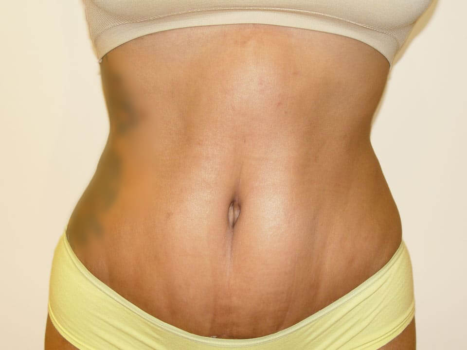 Before & After Patient