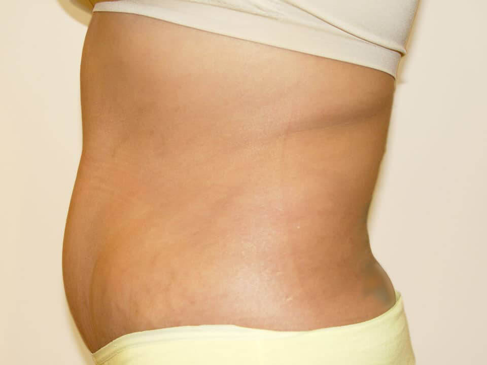 Before & After Patient