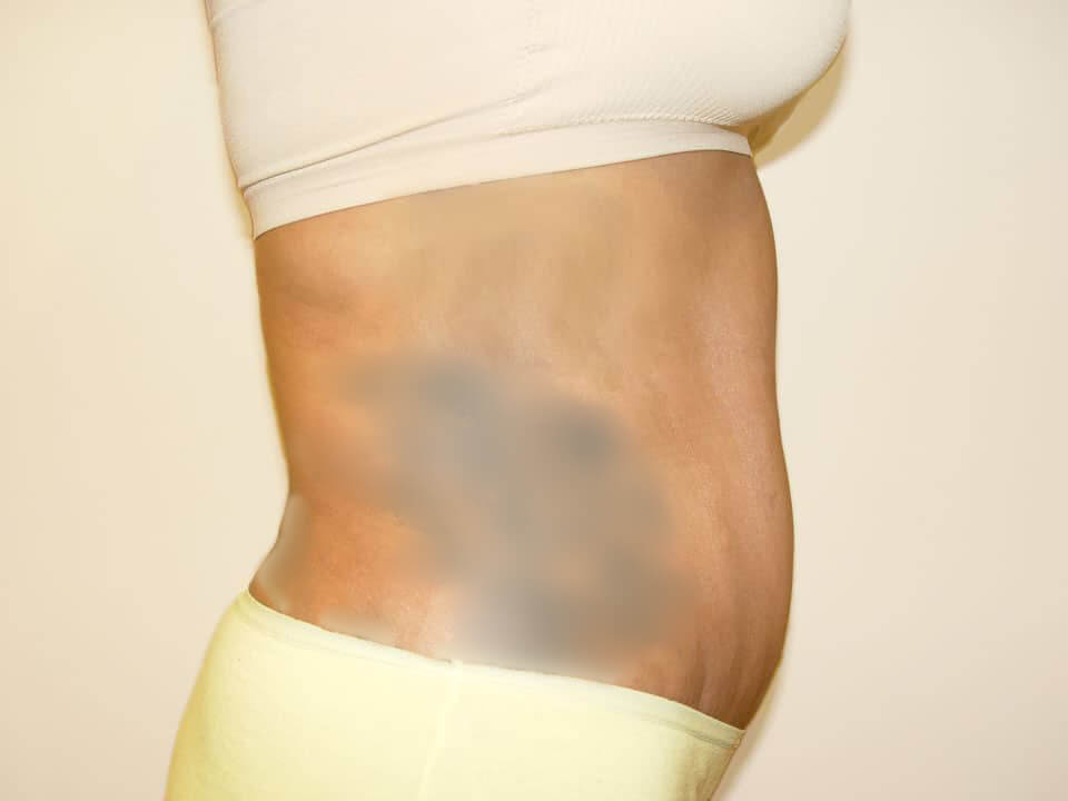 Before & After Patient