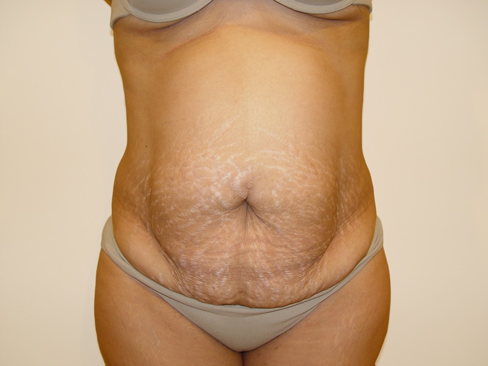 Before & After Patient