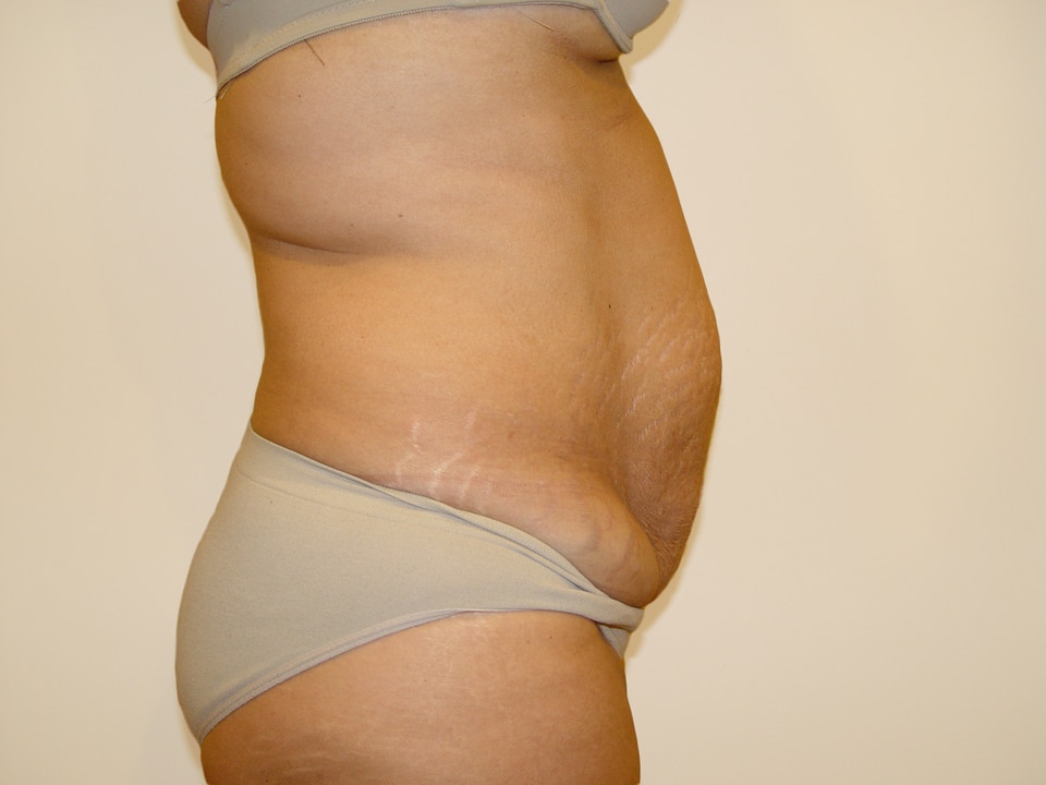 Before & After Patient