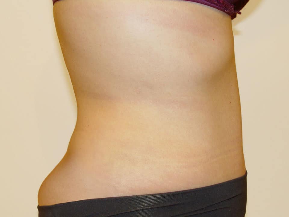 Before & After Patient