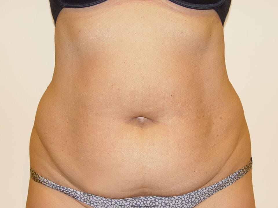 Before & After Patient