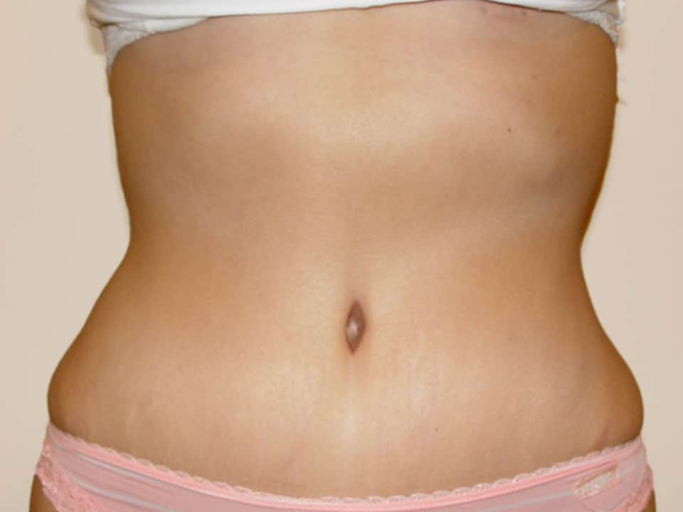 Before & After Patient