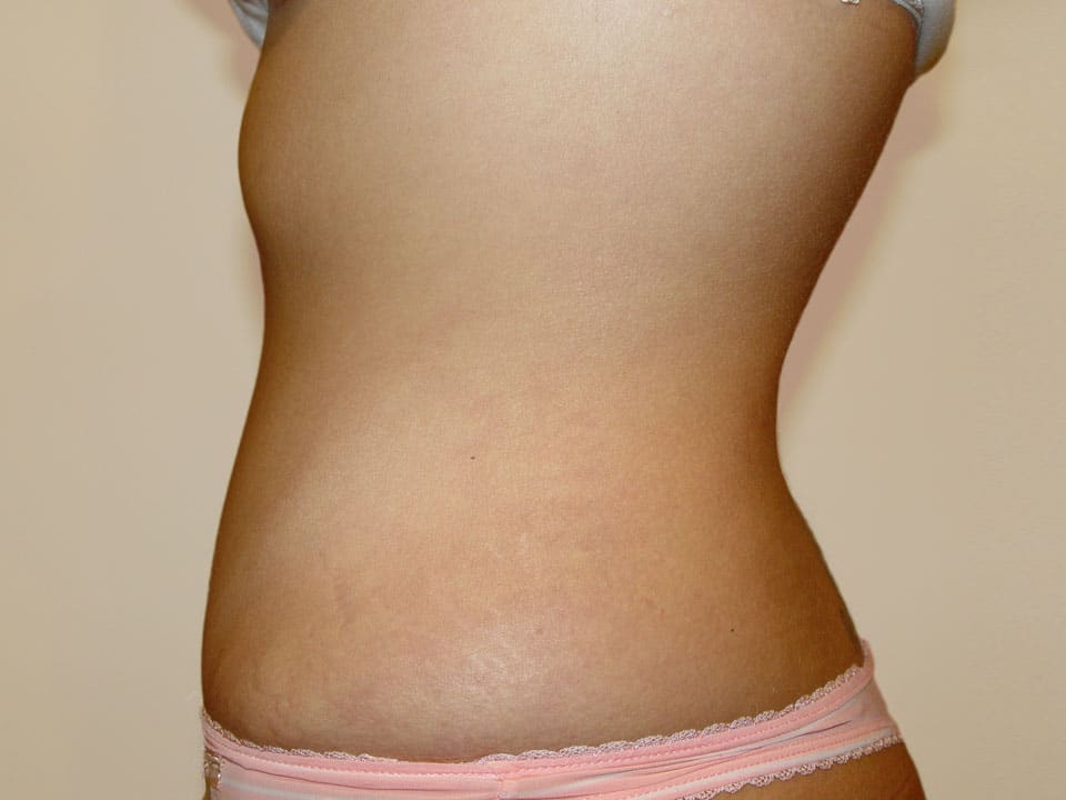 Before & After Patient