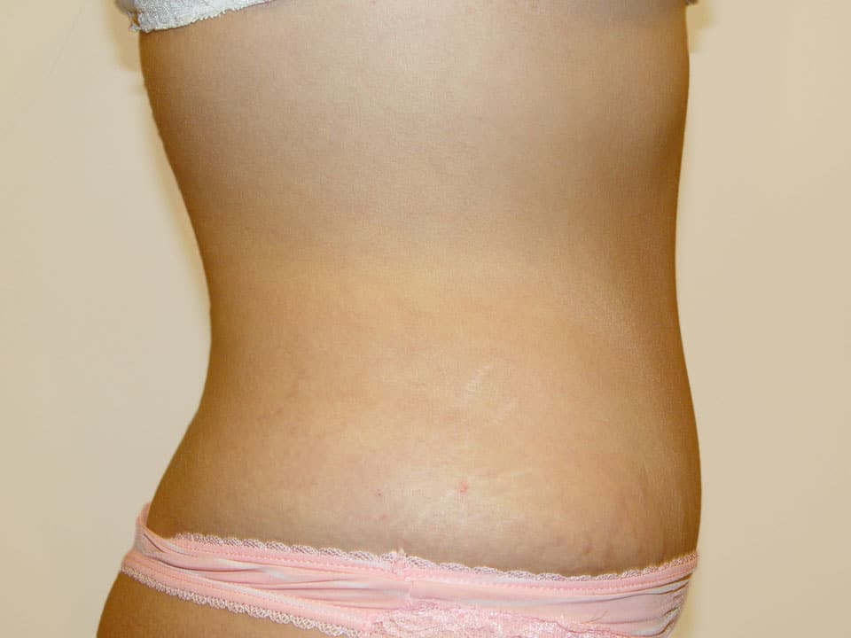 Before & After Patient