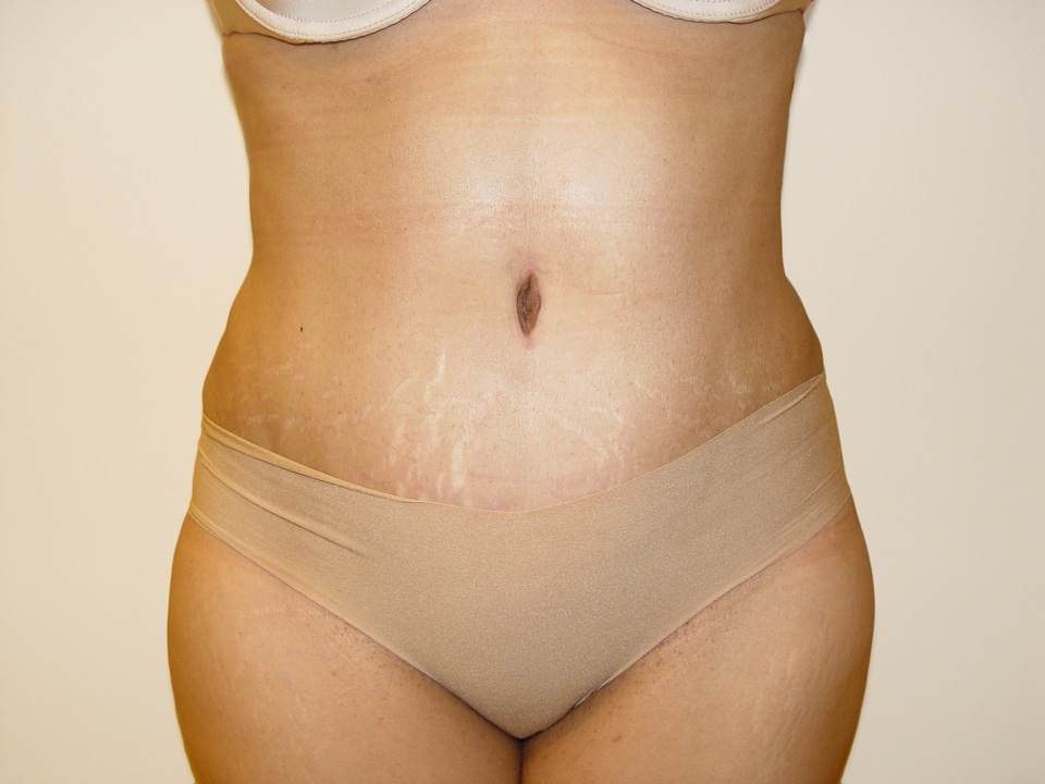 Before & After Patient