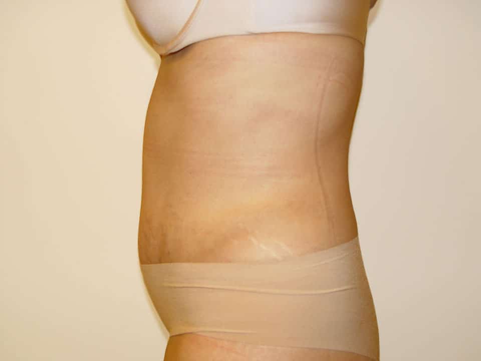 Before & After Patient