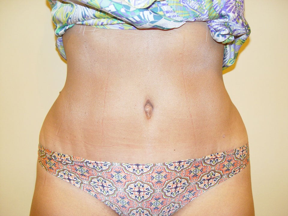 Before & After Patient